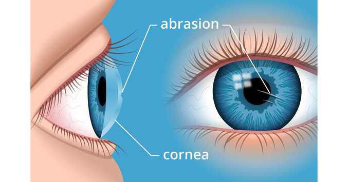 This is an illustration of a corneal abrasion, shown on a blue background. On the left side of the image, the shape of a person's eye is shown from a sideview, indicating the part of the eye that is the cornea, and an abrasion (scratch) in the cornea. On the right side of the image, the same abrasion is shown from the frontal view.