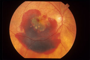 An image of an eye with wet macular degeneration.